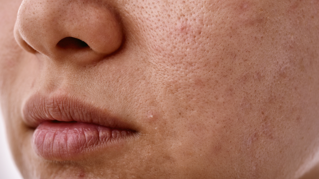 peau complexe avec des taches et des boutons