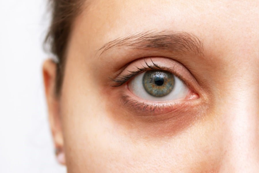 Les Cernes Noirs Sous Les Yeux : Causes et Solutions Efficaces - Kósmopellis