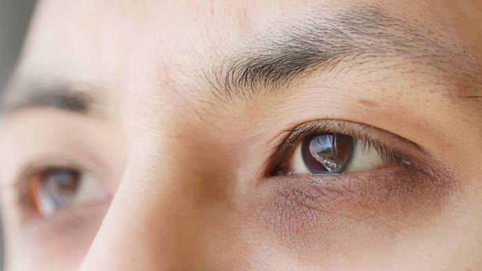 Dark circles: The best tips to get rid of them