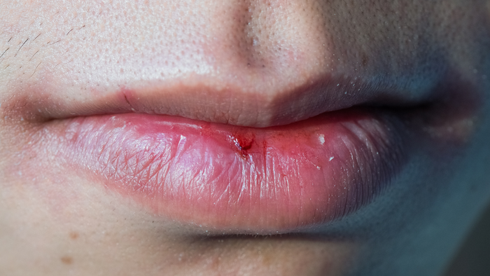 Repairing Damaged Lips: Tips and Tricks