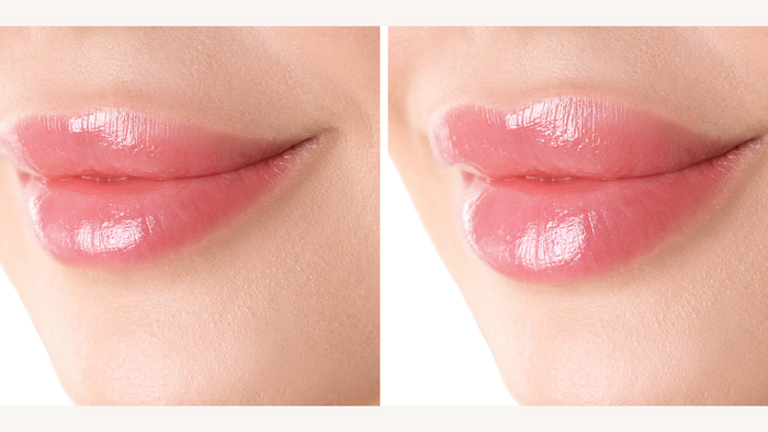 Hyaluronic acid for lips: all you need to know