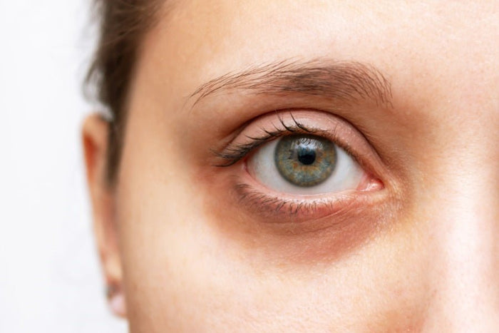 Dark Circles Under Eyes: Causes and Effective Solutions