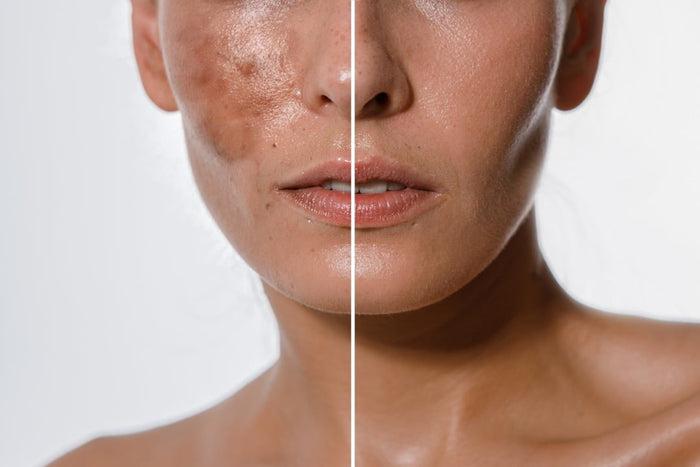 Masque de Grossesse : Comment Éviter les Imperfections Pendant la Grossesse