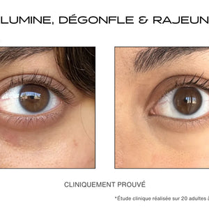 Avant / Après cernes pour le patch contour des yeux microneedling