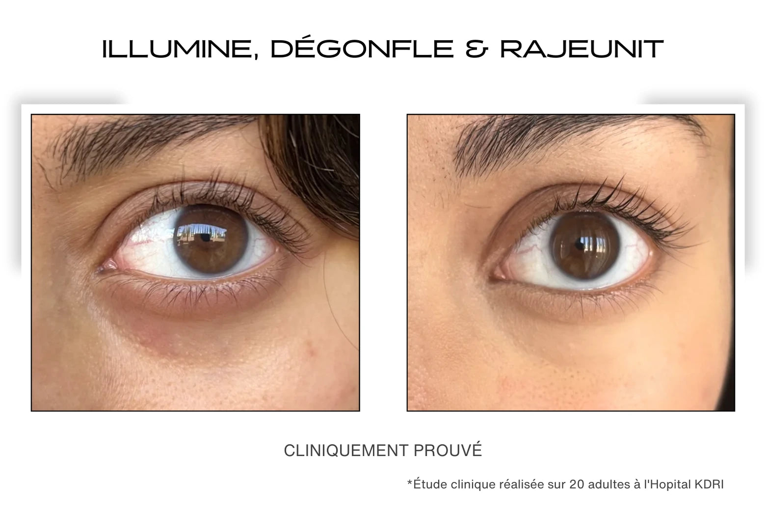 Avant / Après cernes pour le patch contour des yeux microneedling