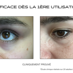 Avant / Après sur les cernes pour le patch contour des yeux microneedling