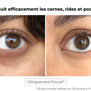 Avant / après patch contour des yeux Kósmopellis — effet lissant visible et regard éclatant