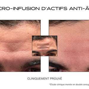 Avant / Après pour le patch anti-rides microneedling sur le front