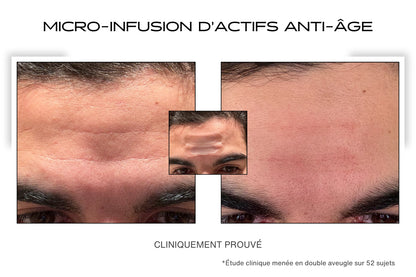 Avant / Après pour le patch anti-rides microneedling sur le front