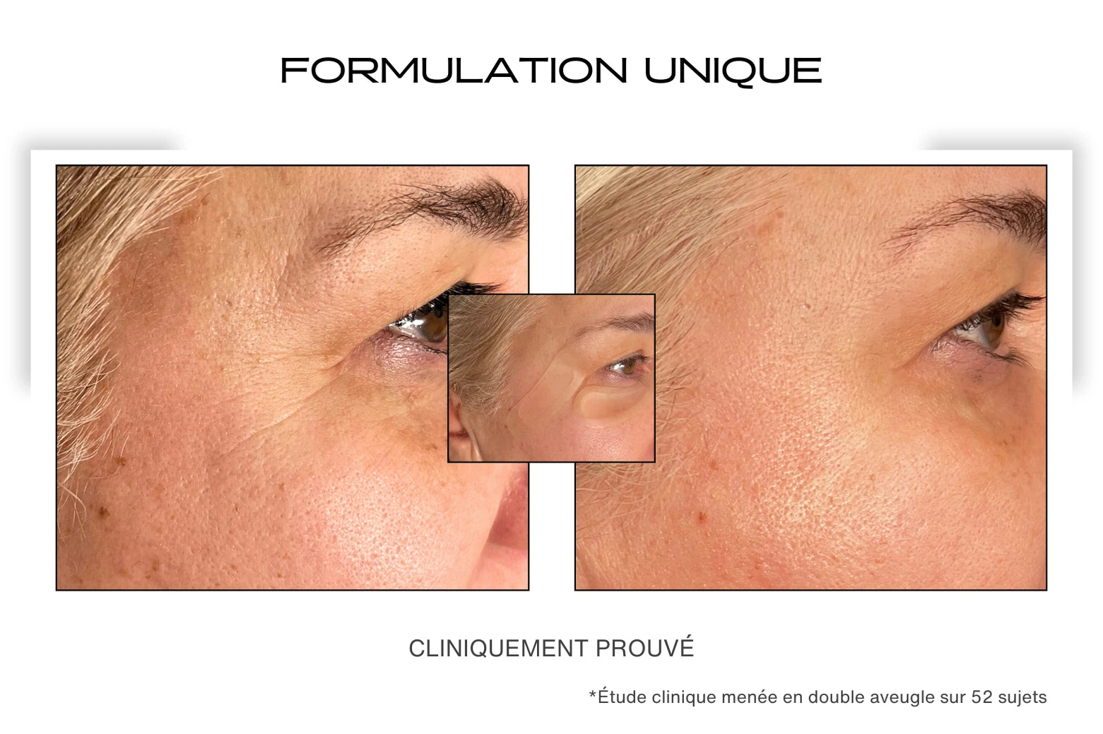 Avant / Après utilisation du patch anti-rides sur les pattes d'oies