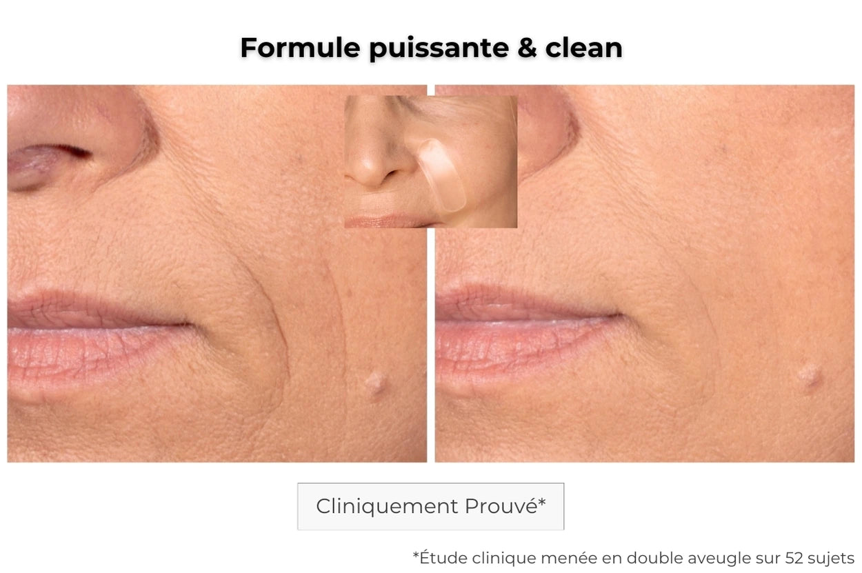 Patch Anti-Âge Microneedling | Traitement des Rides en Profondeur ...