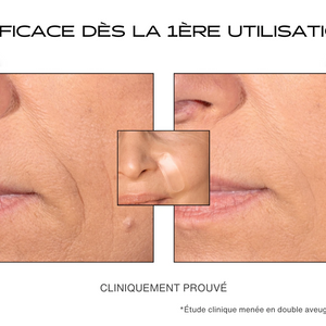 Avant / Après pour le patch anti-rides sur le sillon nasogénien