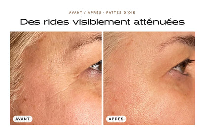 Avant / après : rides des pattes d'oie visiblement atténuées avec le Patch Anti-Âge