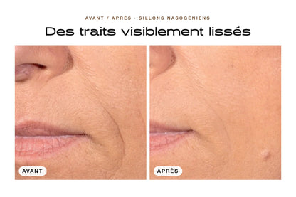 Avant / après : sillons nasogéniens visiblement lissés avec le Patch Anti-Âge