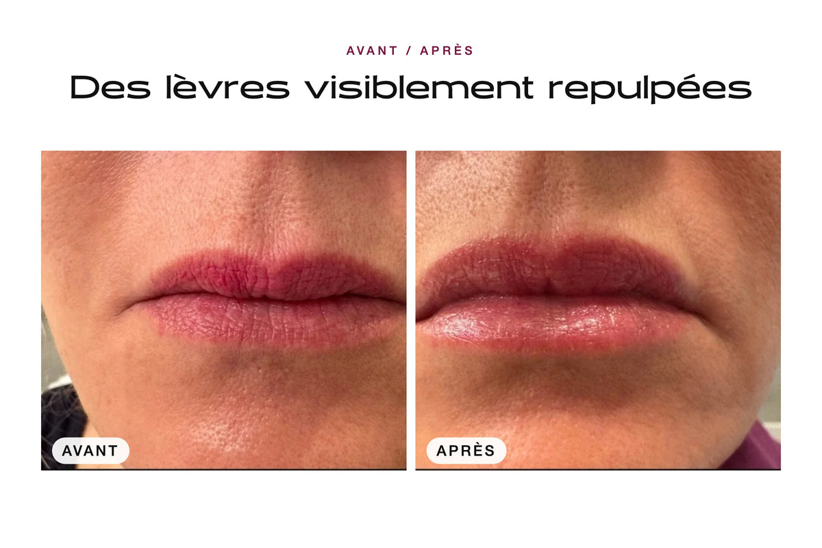 Avant / après : lèvres visiblement repulpées avec le Patch Lèvres
