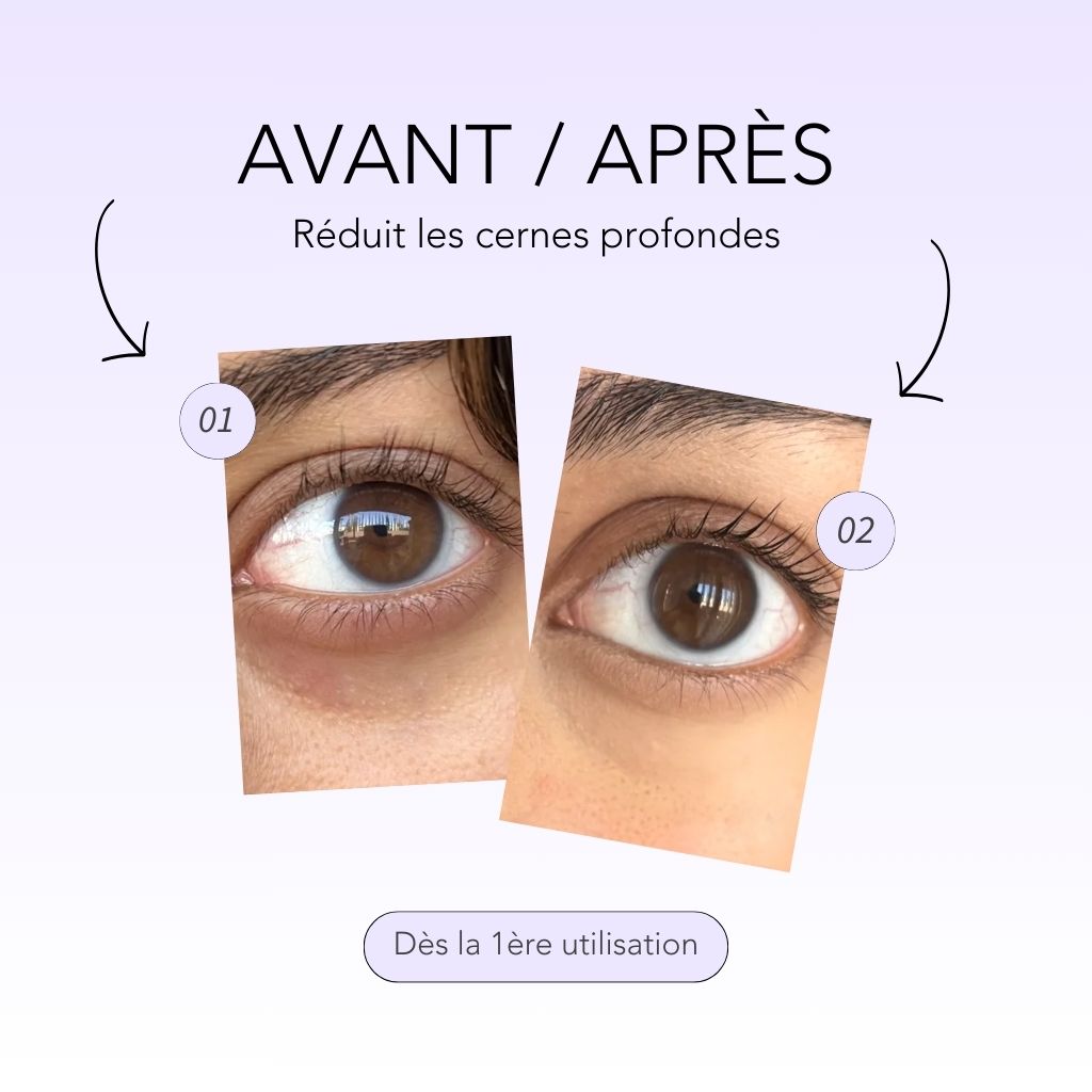 Résultats anti-rides, anti-cernes et anti-poches pour le patch contour des yeux microneedling