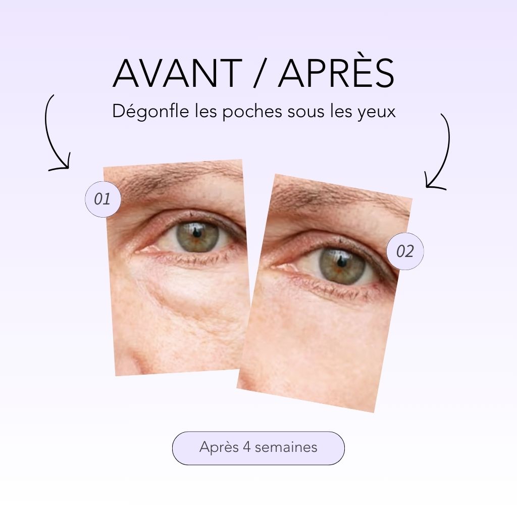 Résultats anti-rides, anti-cernes et anti-poches pour le patch contour des yeux microneedling